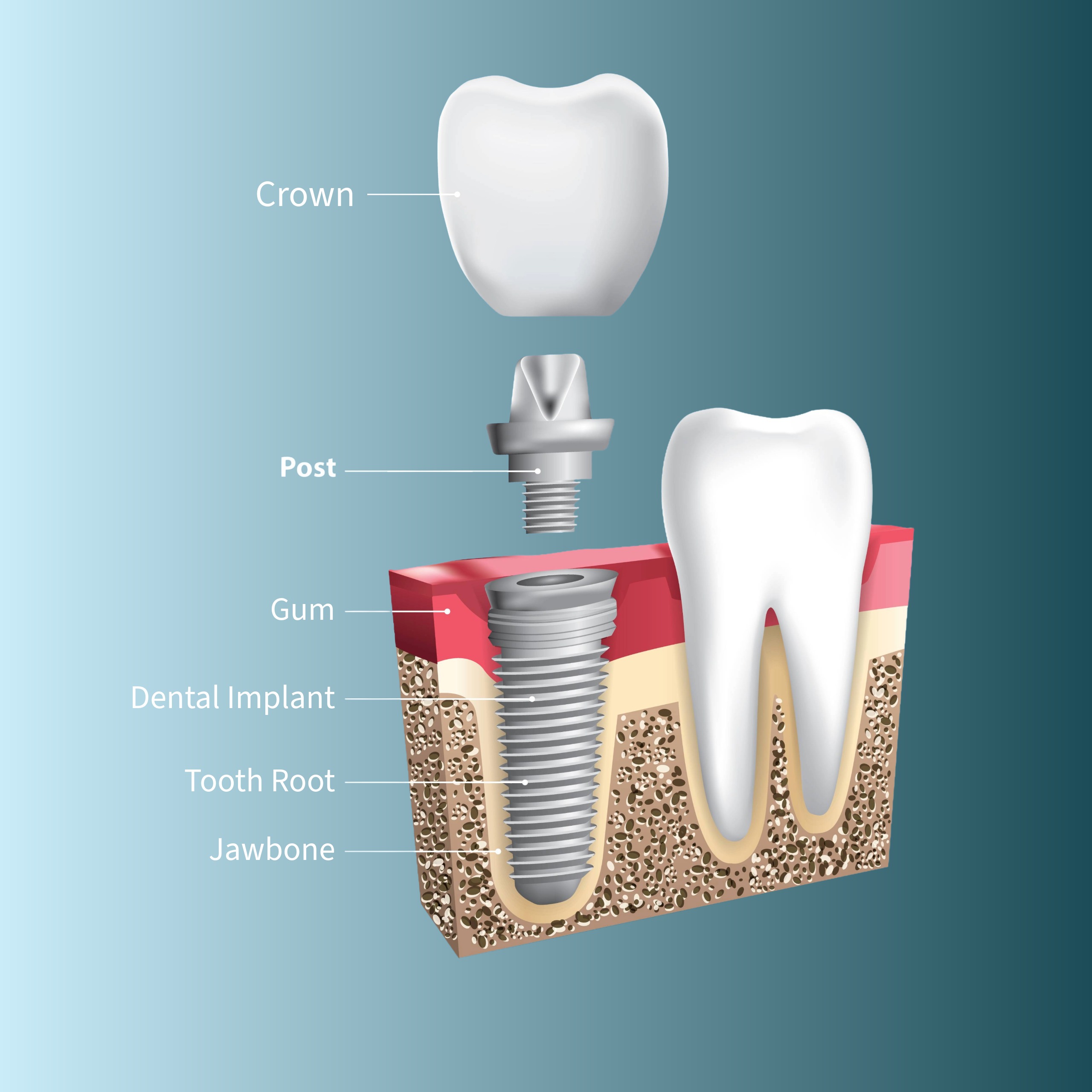 SINGLE DENTAL IMPLANT