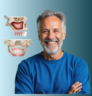Zygomatic Dental Implants