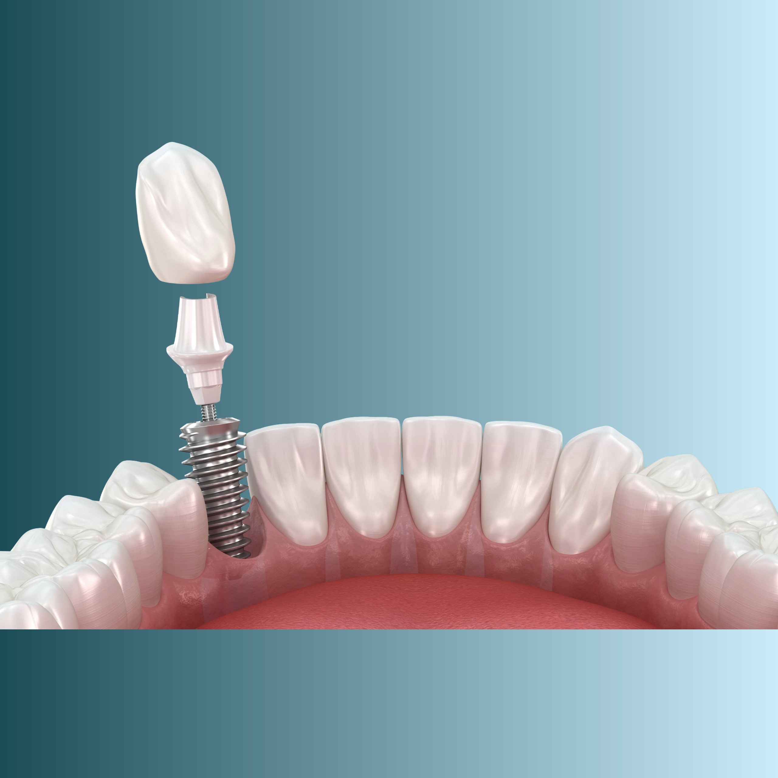 DENTAL IMPLANTS
